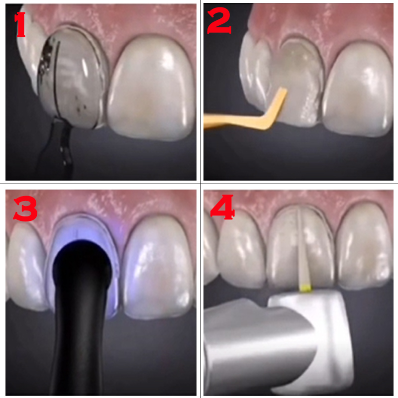 Stampo per faccette dentali st - Teeth Whitening Moulds recensione e prezzo